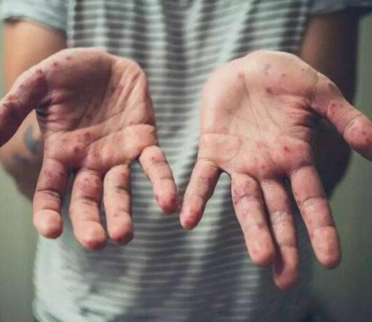 جدري القردة