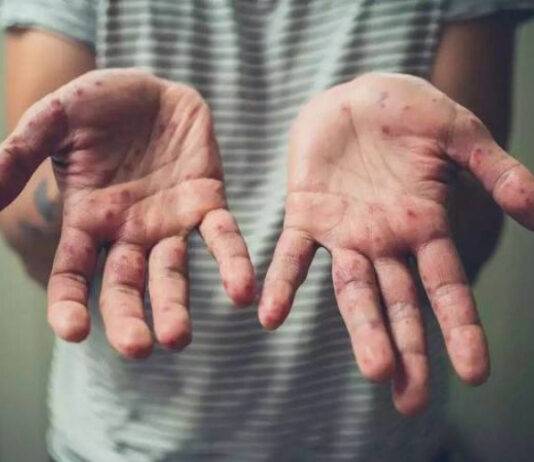 مصر تعلن رصد أول إصابة